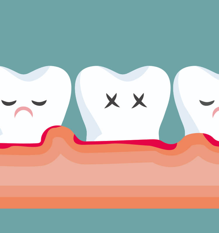 お口の健康は食事から！歯周病予防のための「食べ方」の基礎知識