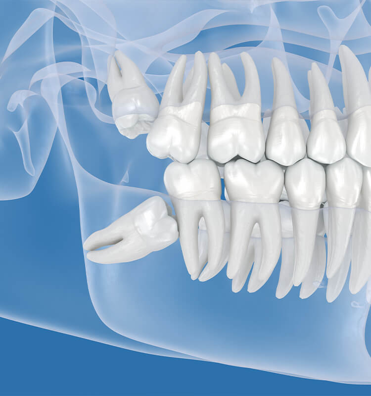 親知らず、抜くべき？抜かなくていい？歯科医が教える判断基準