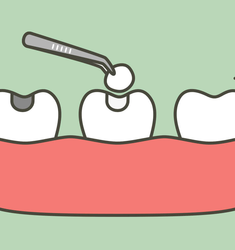 詰め物が取れた！歯医者に行くまでに「やってはいけないこと」3選